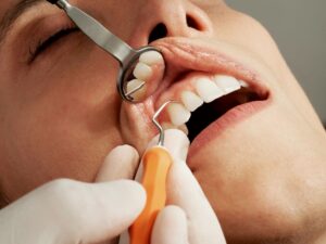 PERCHÉ È IMPORTANTE RIPRISTINARE I DENTI PERSI